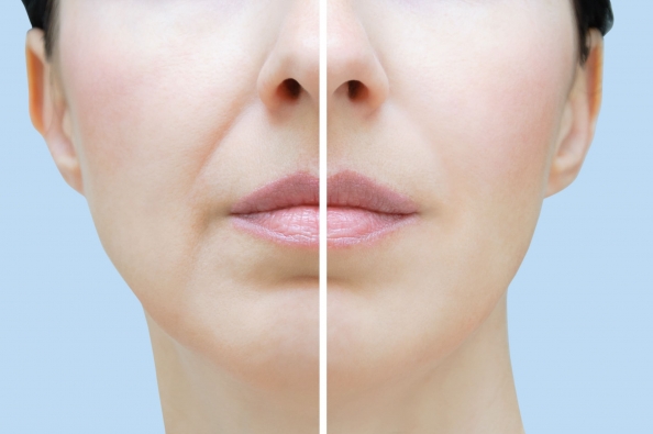 Как избавиться от брылей на лице: липолитики, нити, филлеры и другие  процедуры косметологии — Институт Пластической Хирургии на Трубной