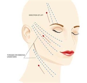 ribbon-and-thread-lifts.jpg