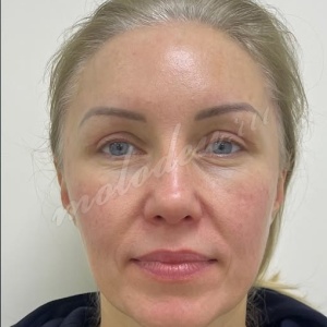 Лобно-височный + блефаро_Гусев