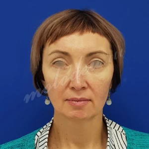 Круговая блефаропластика Гоглов