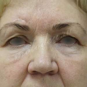 Плотникова_блефаропластика_2022_1