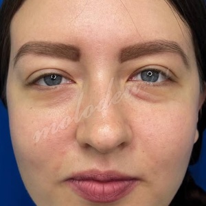 Трансконъюктивальная _гусев