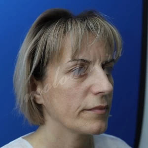 Блефаропластика_Агаев