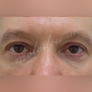 Трансконъюктивальная_Гусев