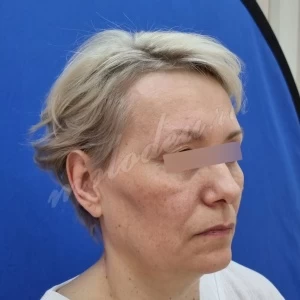 Лобно височный+блефаро_Колбасин