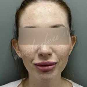 Отопластика_Делецкий