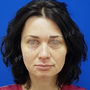 Блефаропластика Гоглов_25.10