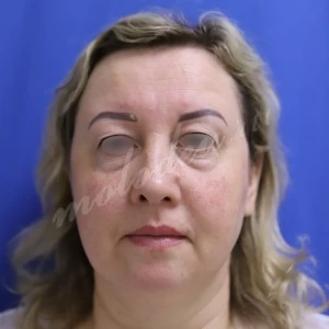 Блефаропластика Мирзарахимов