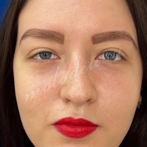 Трансконъюктивальная _гусев