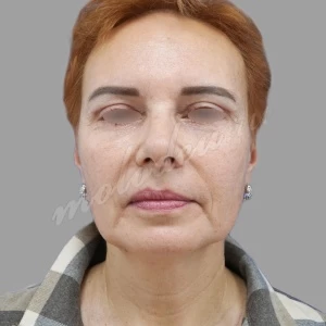 Блефаро_Агаев