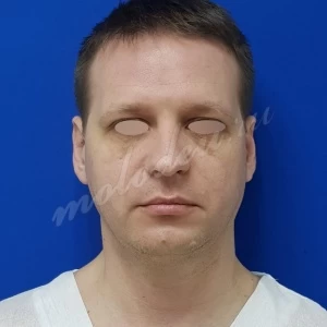 Блефаропластика Гоглов