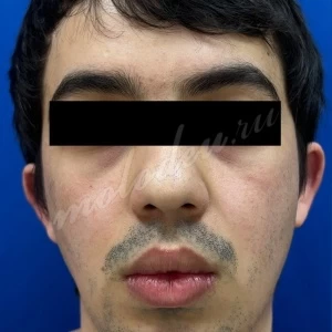 Коррекция ушной раковины_Гусев