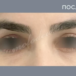 Блефаропластика_Каракаева