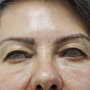 Плотникова_блефаропластика_2022_4