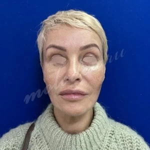 Блефаропластика Мирзарахимов