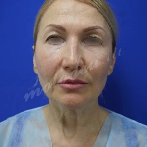 Блефаропластика Пирмагомедов