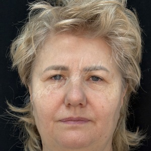 Лобно височный _Гусев