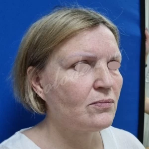 Чек лифтинг Колбасин