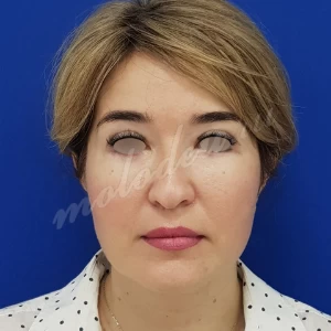 Круговая блефаропластика Гоглов 20-01-2021