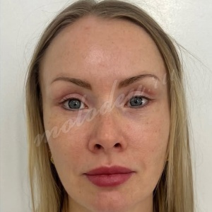 Лобно-височный + блефаро_Гусев