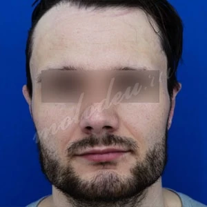 Пирмагомедов_отопластика_05.05