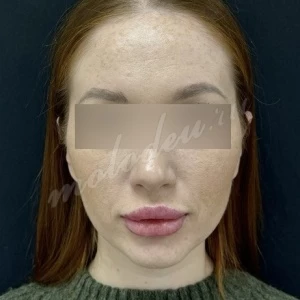 Отопластика_Делецкий