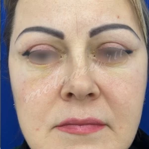Блефаропластика_Гусев