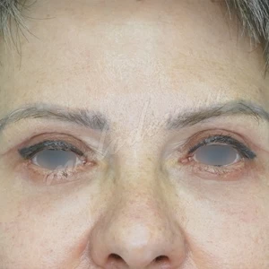 Плотникова_блефаропластика_2022_4