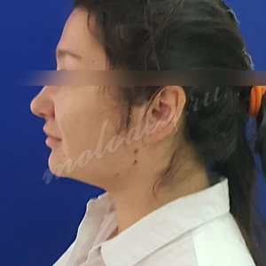 Липосакция Гоглов