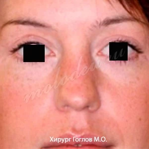 Блефаро Гоглов М.О.