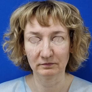 Блефаропластика Гоглов
