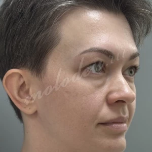 Верхняя блефаропластика_Делецкий