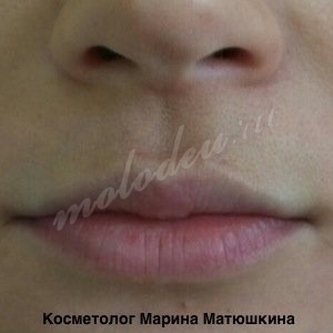 Увеличение губ. Матюшкина