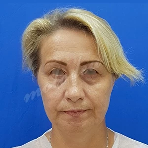Блефаропластика Гоглов_21.09.20