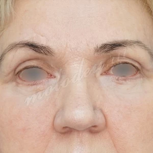 Плотникова_блефаропластика_2022_1