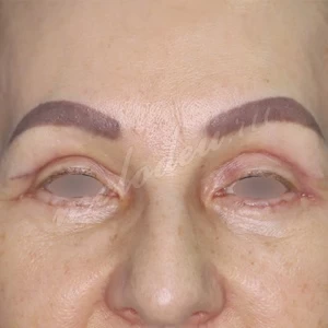 Плотникова_блефаропластика_2022_3