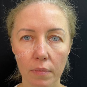 Лобно-височный + блефаро_Гусев