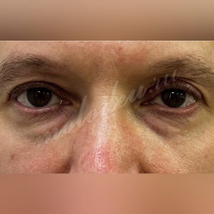 Трансконъюктивальная_Гусев