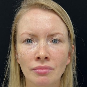 Лобно-височный + блефаро_Гусев