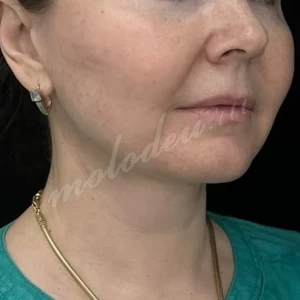 Гусев_нижняя подтяжка