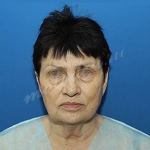Гоглов_блефаропластика_01.05.21